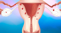 Курсовка Лечение эндометриоза и миомы матки